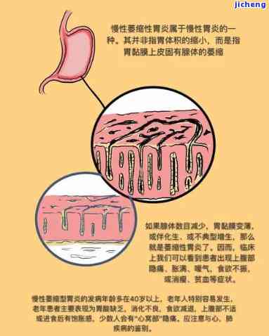 萎缩性胃炎患者适合饮用茶油吗？探讨其治疗效果与养胃作用